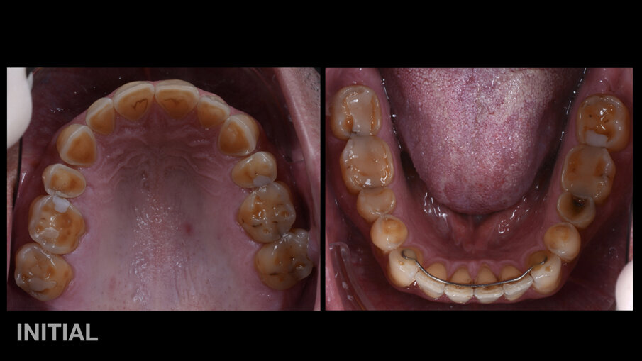 Fig. 1: Situación inicial, imagen intraoral: vista oclusal.