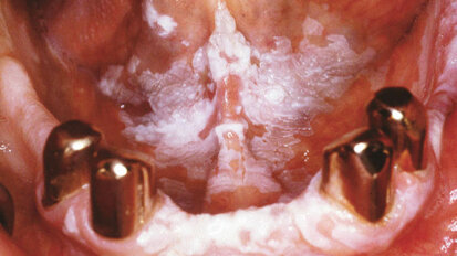 Die Rolle des Geschlechts bei prämalignen Erkrankungen der Mundschleimhaut Die Rolle des Geschlechts bei prämalignen Erkrankungen der Mundschleimhaut