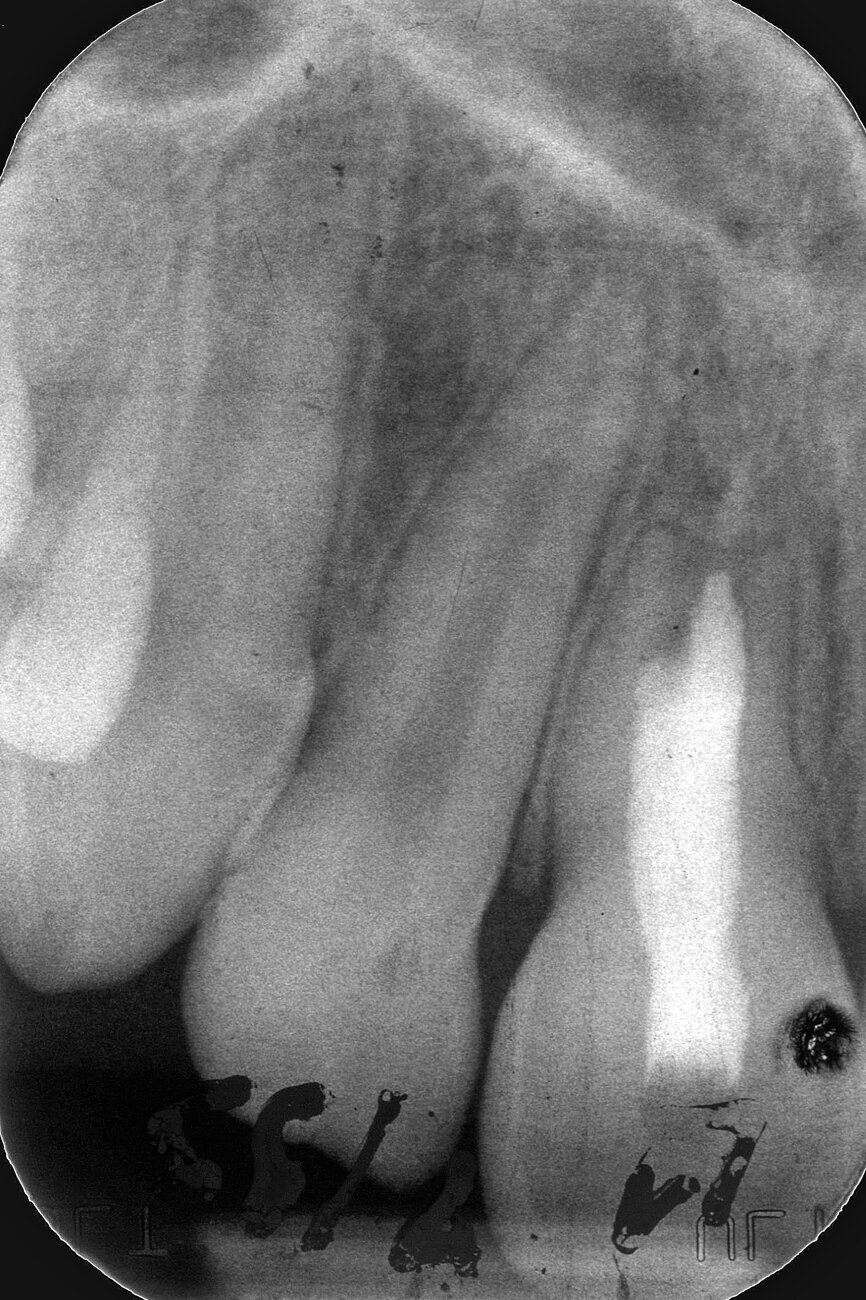 Case 3: Female (born 8 August 1988): Tooth 11
Fig. 5c: 22 April 2002 status.