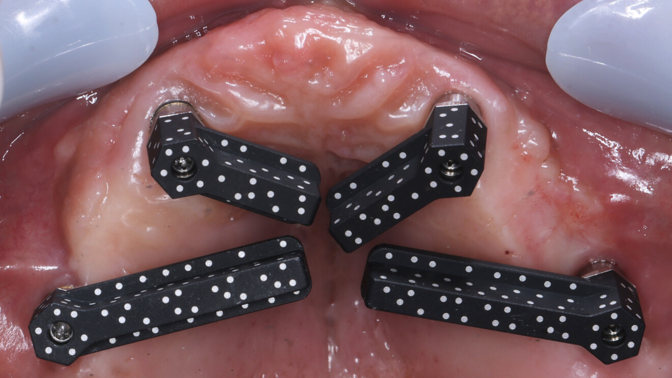 Fig. 17b: Photogrammetric scan bodies connected to the implants for definitive digital impression taking in the maxilla.