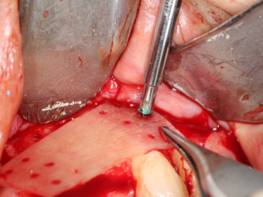 Fig. 10: Holes are placed through the Flexo-Plate Plus and fixation screws are placed to stabilize it on both left and right over the area being grafted.
