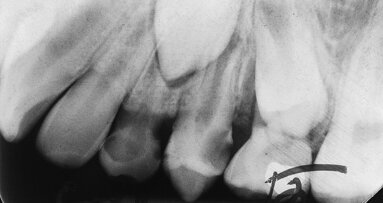 Success evaluation of N2 treated teeth with open apical foramen—A retrospective study