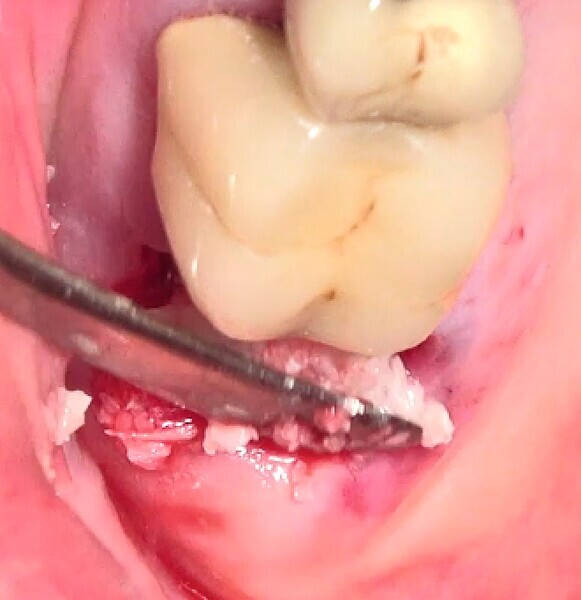 Fig. 53 : Allogreffe constituée d’un substitut osseux et ciment de protection au sulfate de calcium biphasique. 