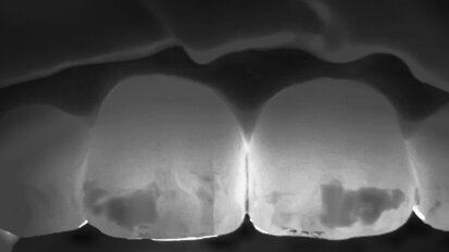 Quando la mini invasività migliora l’estetica: il trattamento di una MIH, dalla microabrasione all’infiltrazione, passando attraverso la remineralizzazione