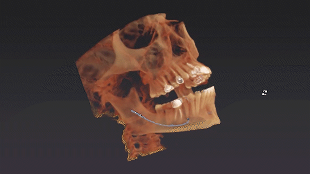 Automatisches Einzeichnen des Mandibularkanals in DTX. © DEXIS