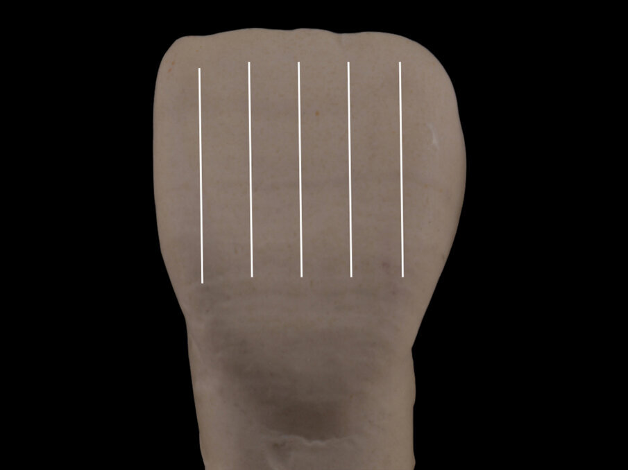 Fig. 7: Distant vertical lines create a balanced expansion of the configuration of the tooth.