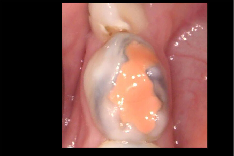 Afbeelding 6. Casus 2: 18-10-18. Fuji Triage ‘noodvulling’ voldoet na 5 maanden.