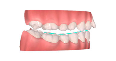 Skeletal and dental Class II, Division I malocclusion solved in 11 months with MTO system: Using Carriere Motion Appliance and clear aligners without extraction