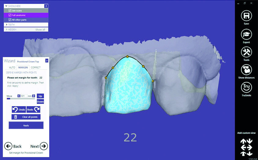 Fig. 15a: Design of the provisional prosthesis, margins set; the irregular initial state of
tooth #22 could be adjusted virtually (a). 3D PICO2 printer (b).