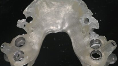 Le nuove tecnologie in implantoprotesi