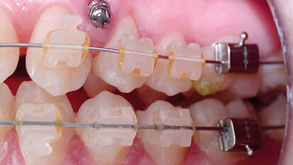 Parodontologisch-kieferorthopädische Behandlung Erwachsener Parodontologisch-kieferorthopädische Behandlung Erwachsener