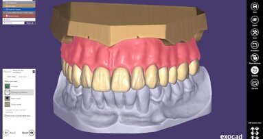 exocad DentalCAD 2.4 Plovdiv现已发布 数字化全口义齿从未如此简单