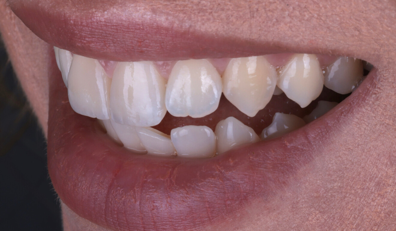 Fig. 22a: Left lateral view of the restorations, showing a natural surface texture.