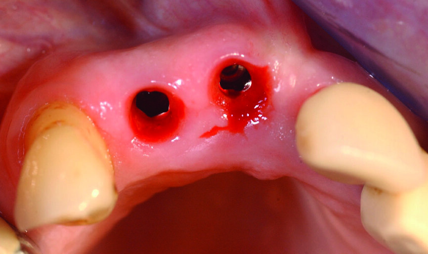 Fig. 10 : Vue clinique à quatre mois post-opératoires après retrait des prothèses provisoires. Notez la qualité et le volume des tissus mous péri implantaires.