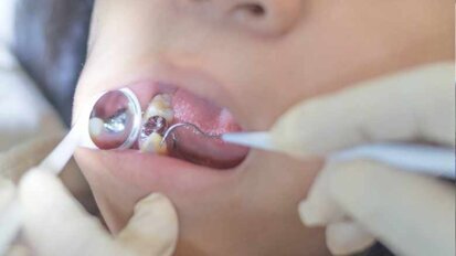 Für den Erhalt von Amalgam – Stellungnahme von BZÄK und KZBV