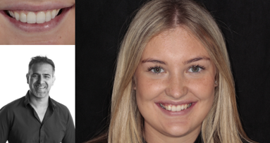 Esthetische orthodontische oplossing als alternatief voor grote restauraties