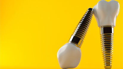 Trends in dentistry: What is currently happening in implantology?