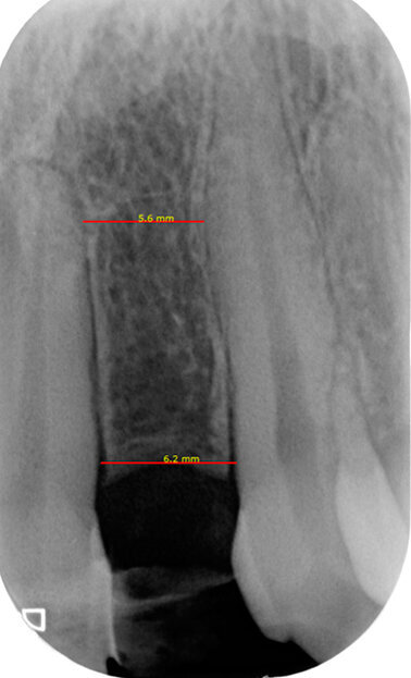 Fig. 4a - Rx endorale pre-operatoria sito edentulo sede 22. Misurazione dello spazio inter-radicolare per l’inserimento dell’impianto.