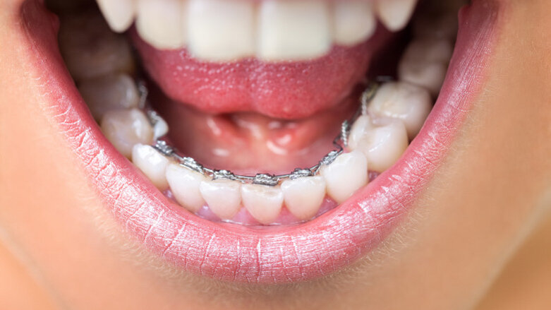 Study finds Saudi Arabians prefer lingual brackets and clear aligners