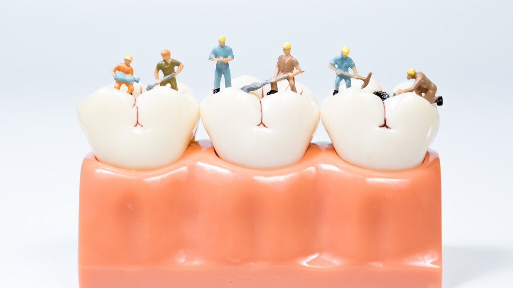 Largest study to date on dental caries experience in Norwegian adult population