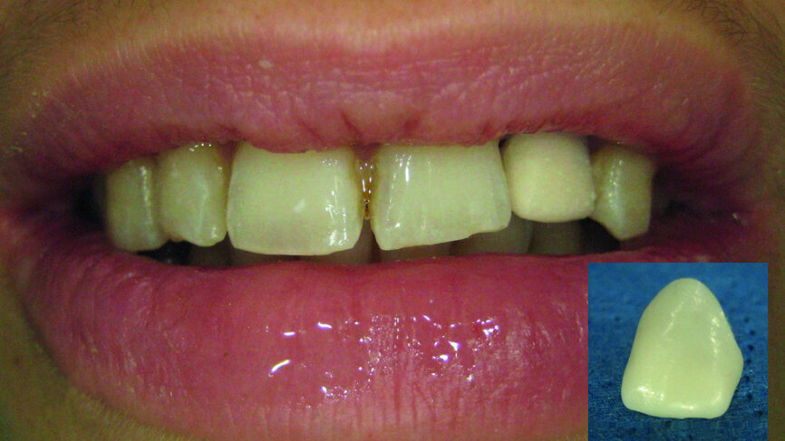 Figs. 17a & b:
Temporary crown printed in 3D set in the mouth (a). Temporary printed restoration after glossing (b).