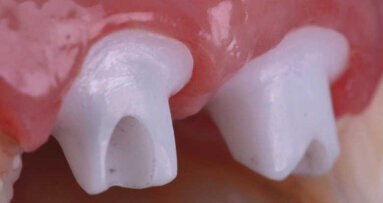 Le défi du remplacement d’incisives adjacentes