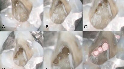 Scouting the root canal with dedicated NiTi files