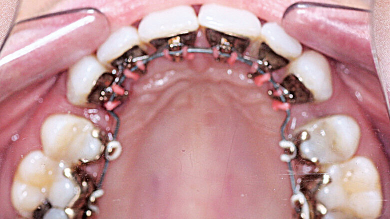 Řešení bimaxilární protruze extrakcemi a lingválním aparátem