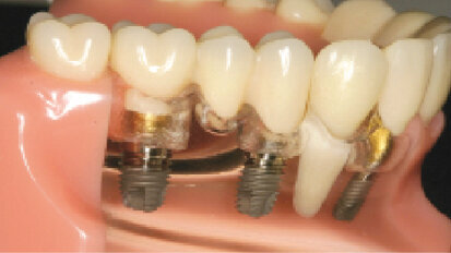 Zjednodušená metoda snímání cementovaných prací na implantátech