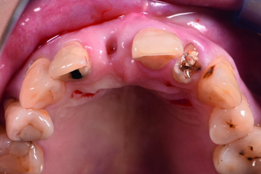 Fig. 2: Pre-op occlusal view of the anterior teeth.