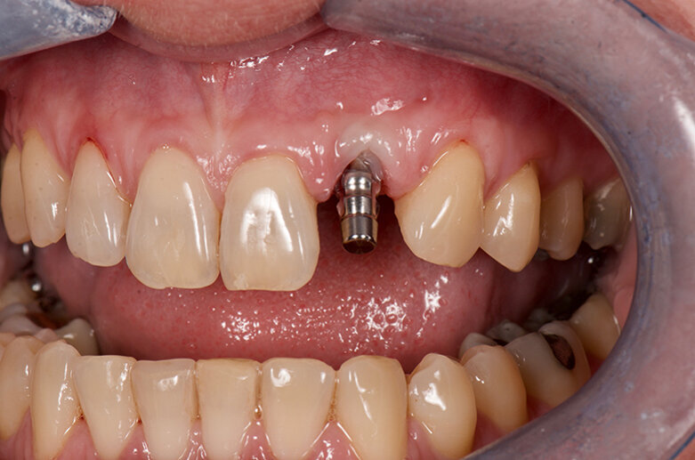 Fig. 9: Clinical view after removal of the provisional restoration and placement of a customised impression coping replicating the emergence profile of the temporary crown. 
