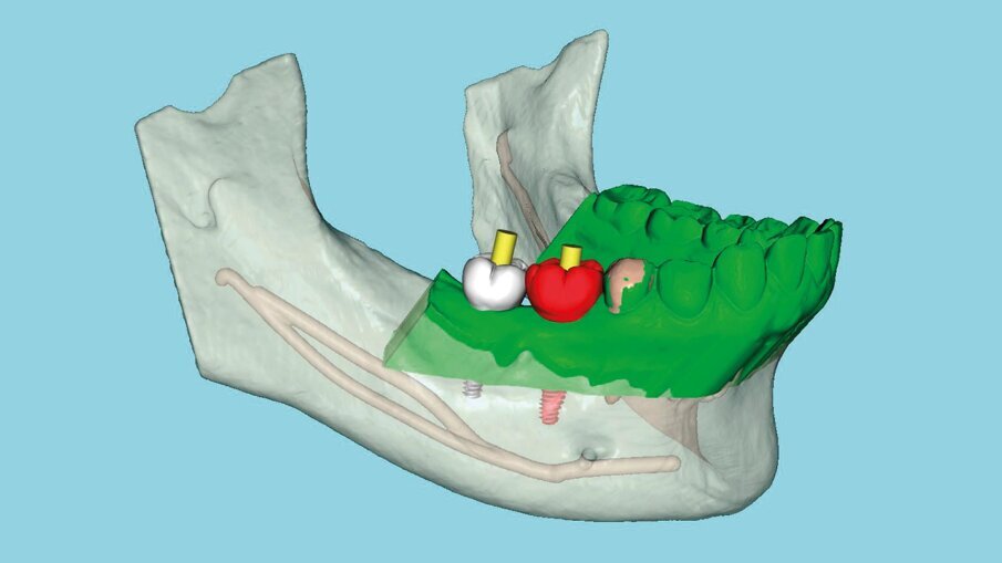 Fig. 1_L’unione dei dati della scansione intraorale (in verde) con quelli della CBCT consente una pianificazione precisa e la realizzazione di una guida chirurgica.