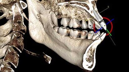 3D imaging: Increasing implant accuracy 3D imaging: Increasing implant accuracy