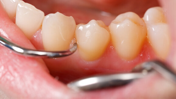 Forscher identifizieren Parodontitis-Bakterium