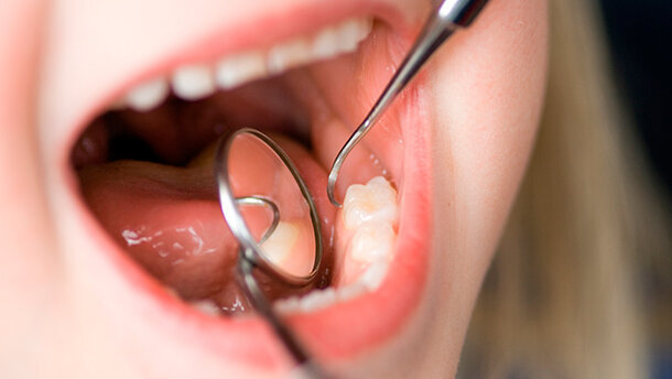 Con la crisi è boom di carie tra i bambini (+15%) (e sta crescendo anche tra i 25enni)