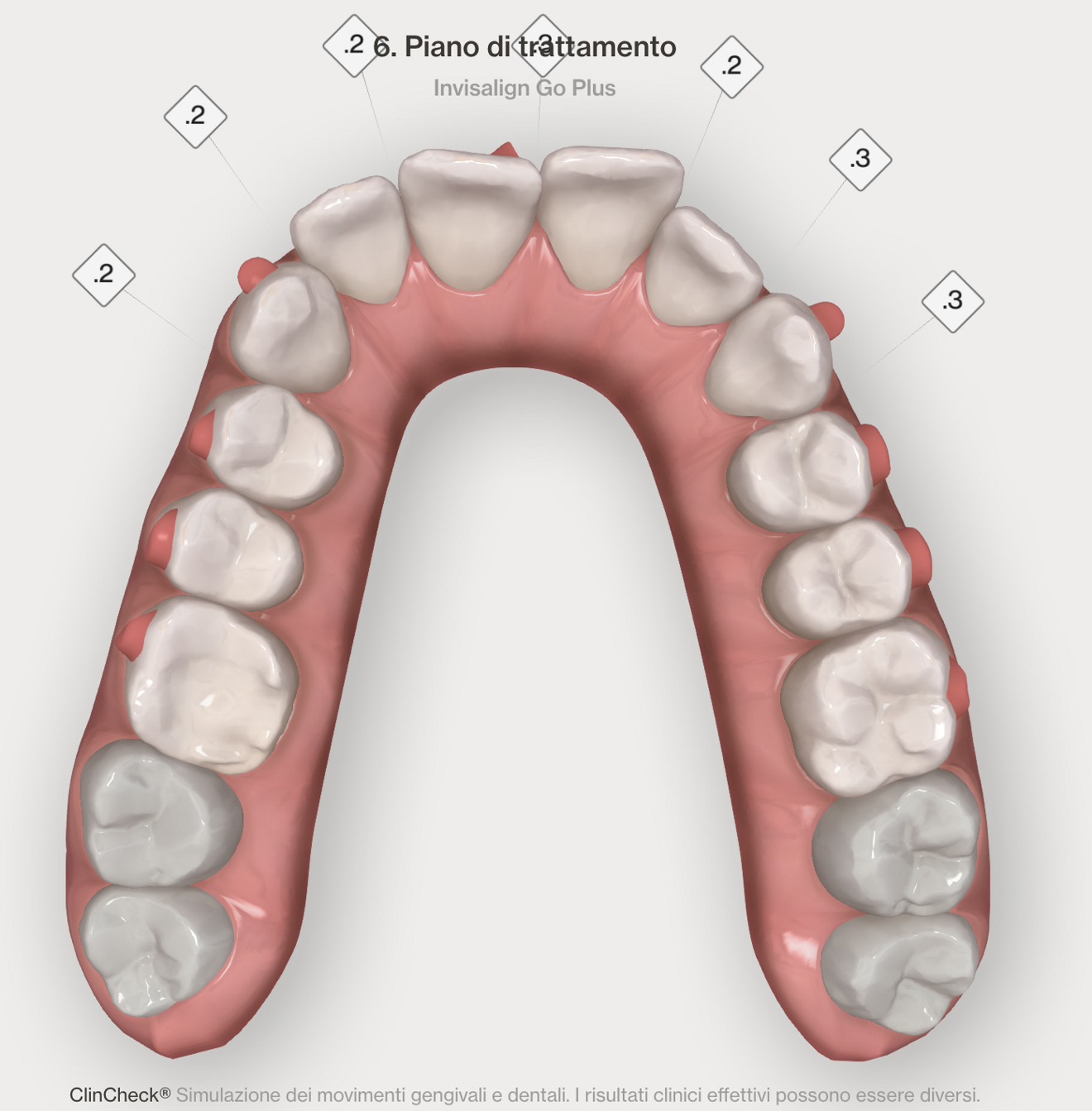 Figg. 4–7 - Pianificazione digitale nelle due arcate prima (Figg. 4, 5) e dopo (Figg. 6, 7). I numeri nel quadrato indicano la riduzione interprossimale pianificata.