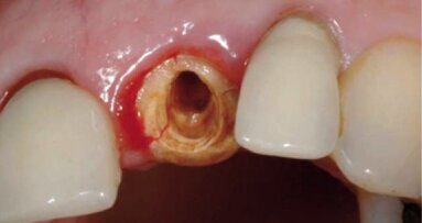 Czy recesja tkanki miękkiej wokół implantów wciąż jest nieunikniona?