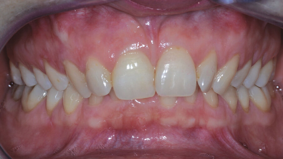 Figg. 10a, 10b_Foto extraorali ed intraorali di inizio trattamento. Il sorriso iniziale della paziente non permetteva una eccessiva intrusione degli incisivi superiori ma, nonostante questo, risulta migliorato il display dentale e l’ampiezza del sorriso.