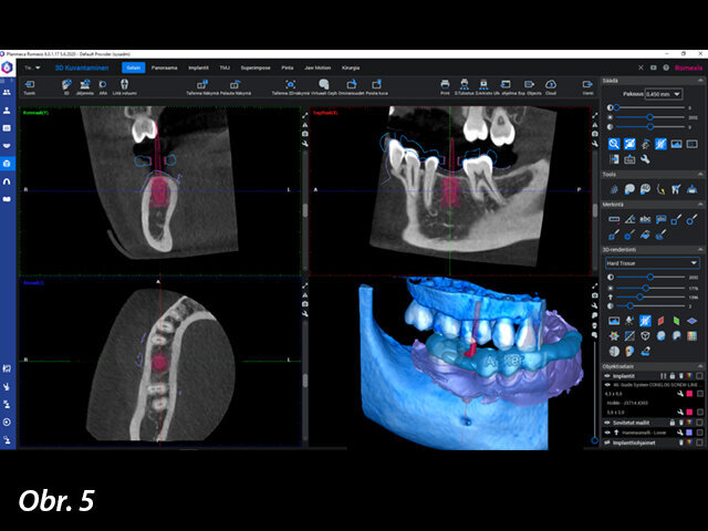 Plánování implantátu bylo provedeno v softwaru Planmeca Romexis.