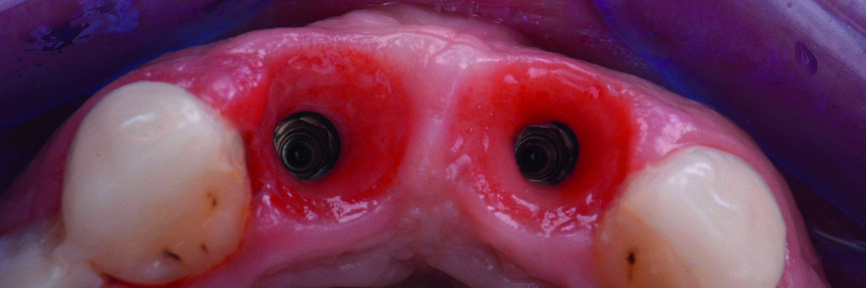 Figs. 25–26 : Après le retrait des piliers provisoires. Le tissu gingival est bien modelé. 