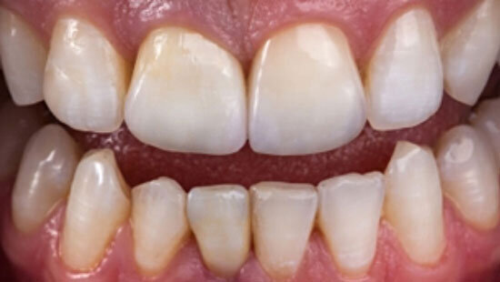 Fig. 11. Las coronas de VITABLOCS personalizadas con VITA AKZENT Plus se fijaron de forma totalmente adhesiva.