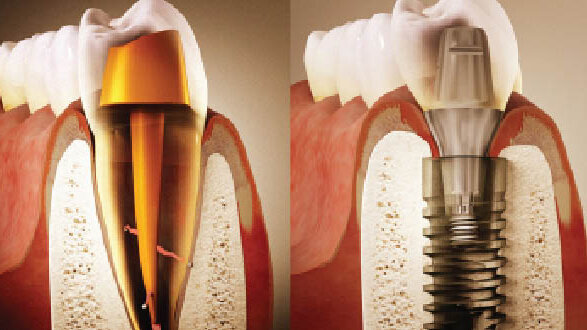 Zpět k počátku… Část II: Endodonticko-implantologický algoritmus založený na důkazech