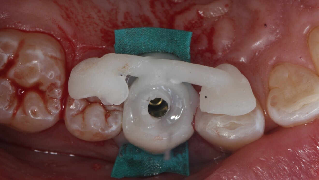 Fig. 10: Intra-oral chairside pick-up of the 3D-printed shell provisional restoration.