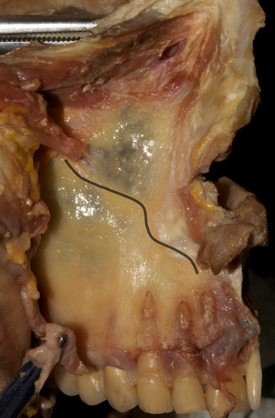 Fig. 2 - Decorso del CS simulato in un preparato anatomico.