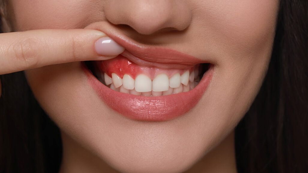 Mundgesundheit und Gehirn: Studie zeigt überraschende Zusammenhänge