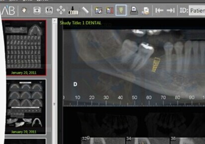AB implants global success spreads rapidly into Canada
