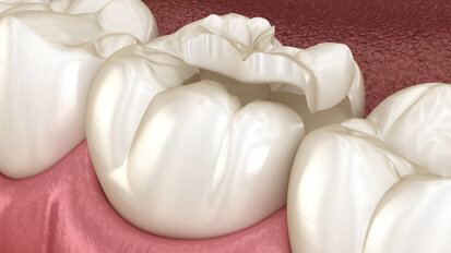 Langzeitbeobachtungsstudie zu Composite-Restaurationen Langzeitbeobachtungsstudie zu Composite-Restaurationen