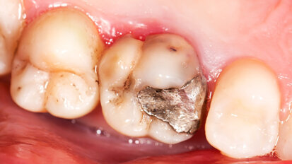 Amalgamverbot negativ für Gesundheitskosten Amalgamverbot negativ für Gesundheitskosten