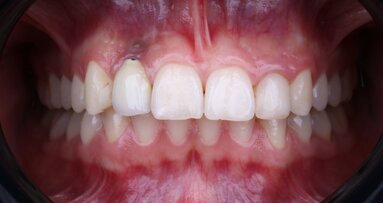 Effective strategies for managing late implant failure and peri-implantitis