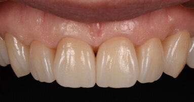 One step closer to nature: Occlusal concepts and sophisticated aesthetics in digital dentistry